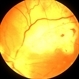 Melanoma, heavy laser #100 Melanoma, heavy laser #100